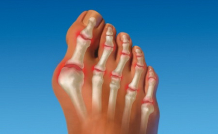 Косточка на большом пальце ноги: причины, лечение, профилактика